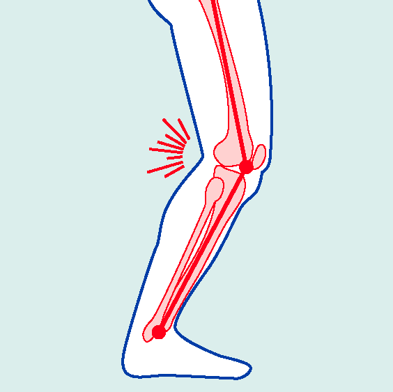 BiomechanicalDeficits-DynamicFlexionCont