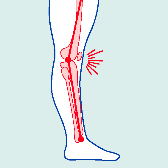 BiomechanicalDeficits-ExageratedExtension