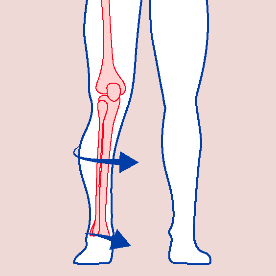 BiomechanicalDeficits-INTTibialRot