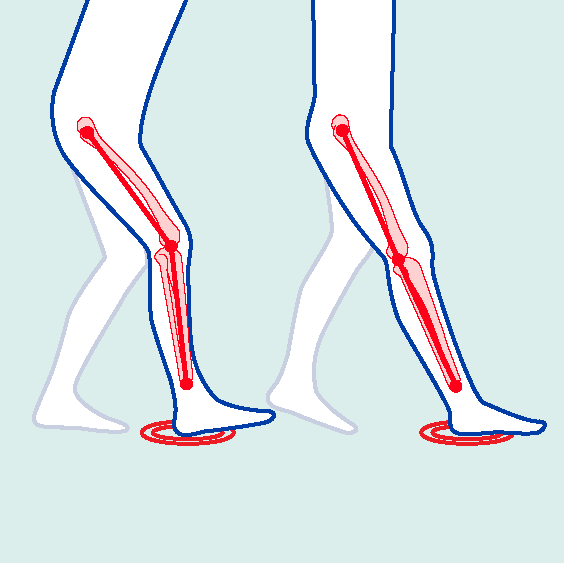 BiomechanicalDeficits-LimitedFlexionMovement