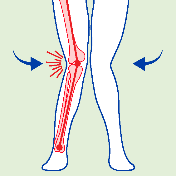 BiomechanicalDeficits-Valgus