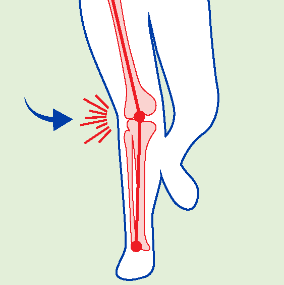 BiomechanicalDeficits-ValgusMovement