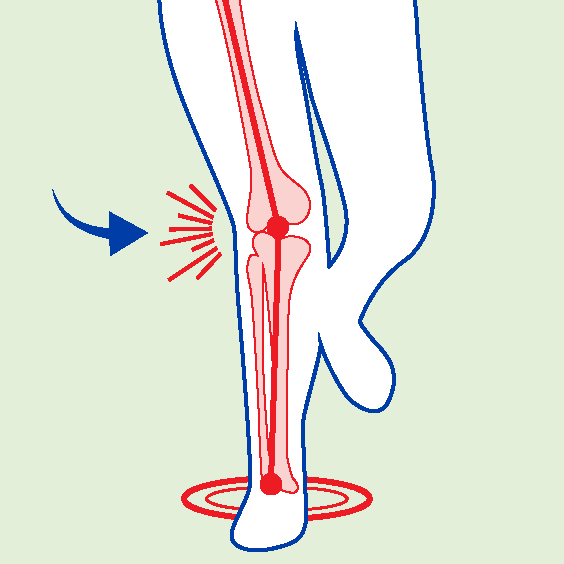 BiomechanicalDeficits-ValgusThrust