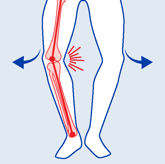 BiomechanicalDeficits-Varus